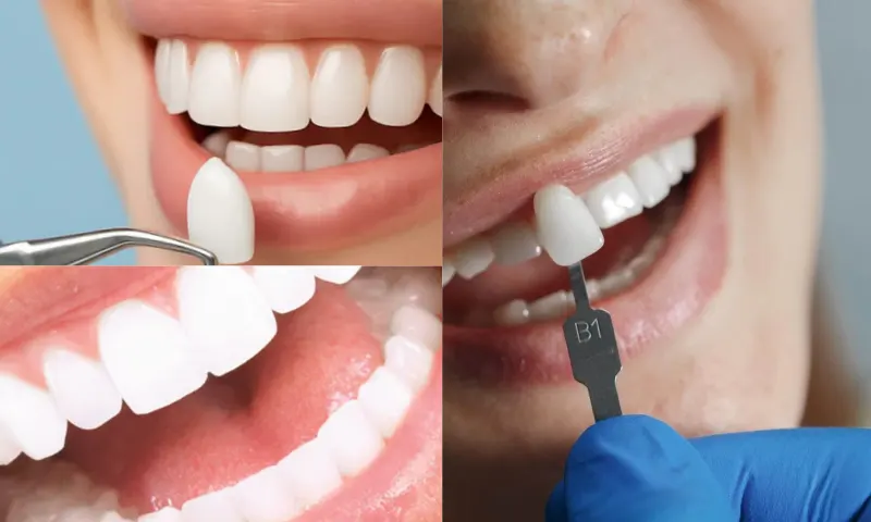 Lamine Diş Kimler İçin Uygundur?