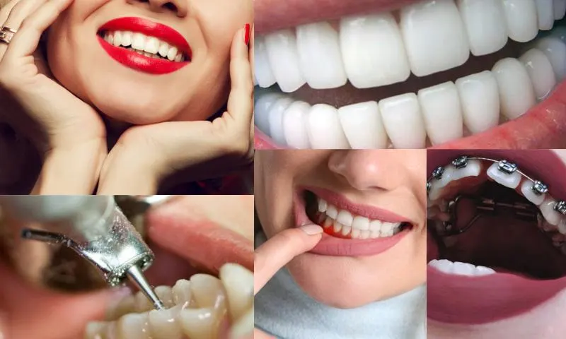 Bleaching (Diş Beyazlatma) Nedir?