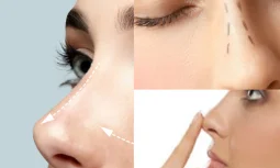 Kapalı Burun Estetiği Kalıcı Sonuç Sağlar Mı?