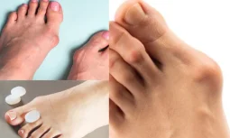 Halluks Valgus Sorunuyla Vedalaşma Hikayem ve Deneyimlerim