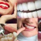 Bleaching (Diş Beyazlatma) Nedir?