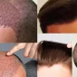 Information About Hair Transplantation